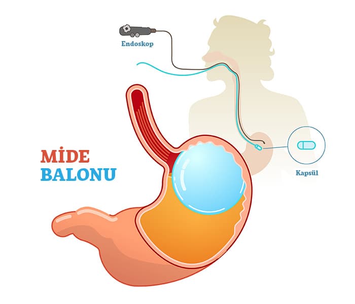endoskopik mide balonu