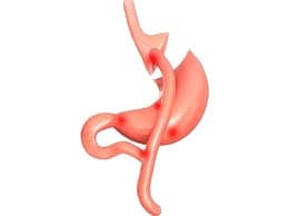 dumping sendromu dumping sendromu