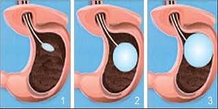 hangi mide balonunu tercih etmeliyim