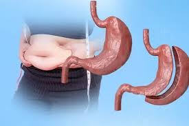 laparoskopik-obezite-cerrahisi laparoskopik obezite cerrahisi