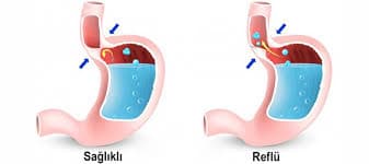 reflu ve tup mide reflu ve tup mide