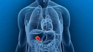 safra kesesi polip 2