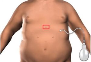 tup mide ameliyati iz azaltma yontemi