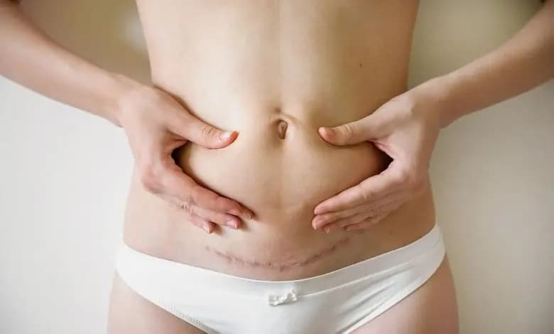 tup-mide-ameliyati-iz-azaltma-yontemleri tup mide ameliyati iz azaltma yontemleri