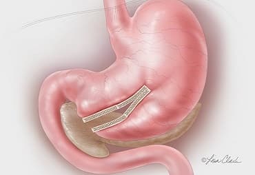tup-mide-ameliyati-teknikler tup mide ameliyati teknikler