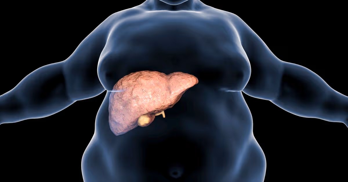 Yağlı karaciğer (MASLD) ve obezite ilişkisi