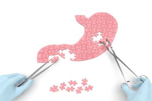Revizyon Obezite Cerrahisi Nedir?