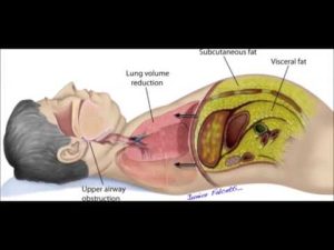 Obezite ve uyku apnesi