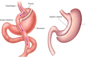 Tüp mide mi, Gastrik bypass mı? 2026 rehberimizde iki yöntemin farklarını, avantajlarını ve size en uygun seçeneği Op. Dr. Güven Görkem analiziyle keşfedin.