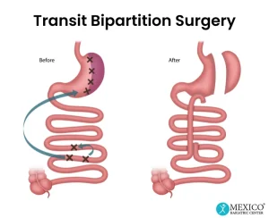 Transit Bipartisyon Nedir? 2026’da Diyabet Tedavisinde En Yeni Metabolik Cerrahi Yöntemi