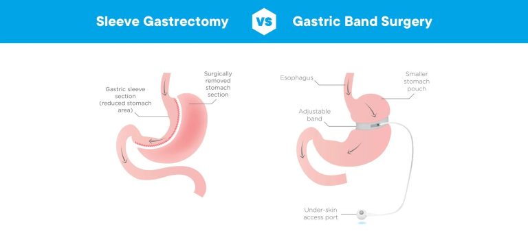 Tüp mide mi, Gastrik bypass mı? 2026 rehberimizde iki yöntemin farklarını, avantajlarını ve size en uygun seçeneği Op. Dr. Güven Görkem analiziyle keşfedin.
