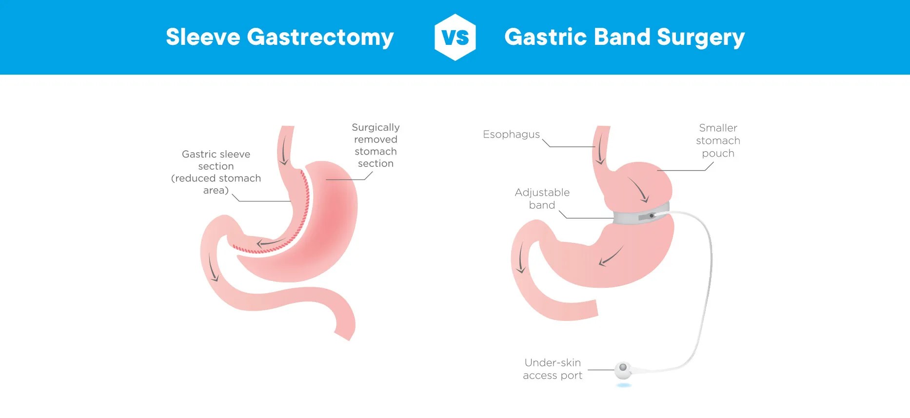 Tüp mide mi, Gastrik bypass mı? 2026 rehberimizde iki yöntemin farklarını, avantajlarını ve size en uygun seçeneği Op. Dr. Güven Görkem analiziyle keşfedin.