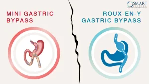 Mini Gastrik Bypass vs. Roux-en-Y Gastrik Bypass: Aralarındaki Temel Farklar Nelerdir? 2026 Rehberi - Op. Dr. Güven Görkem