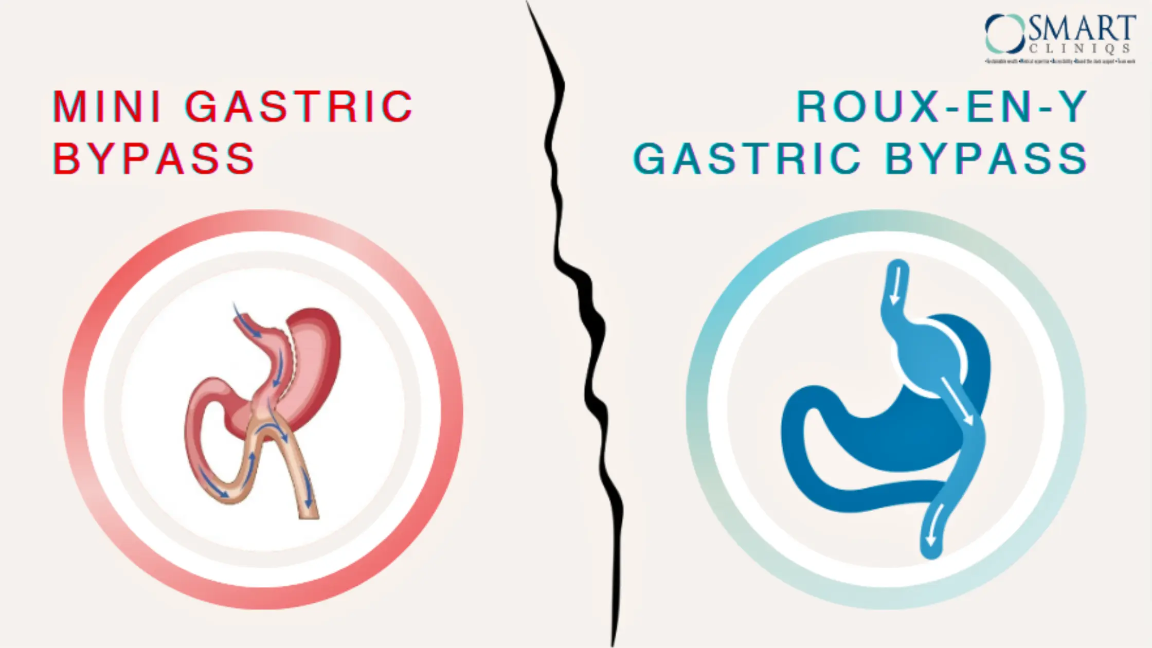 Mini Gastrik Bypass vs. Roux-en-Y Gastrik Bypass: Aralarındaki Temel Farklar Nelerdir? 2026 Rehberi - Op. Dr. Güven Görkem