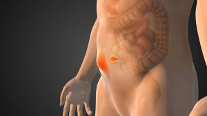 Obezite ve Karın Duvarı Fıtıkları: Cerrahi Müdahale Ne Zaman Yapılmalı? - Op. Dr. Güven Görkem